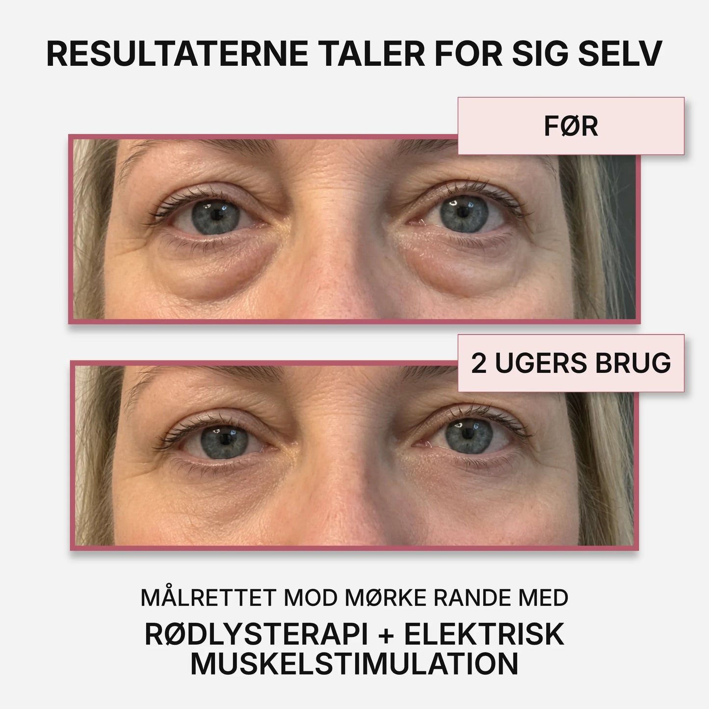 VividEyes™ 2-i-1 Rødlysterapi + EMS til at fjerne mørke rande